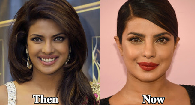 Bollywood actress plastic surgery - priyanka chopra plastic surgery